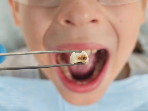 Best Chipped Tooth Repair Near Me  in Plains, MT